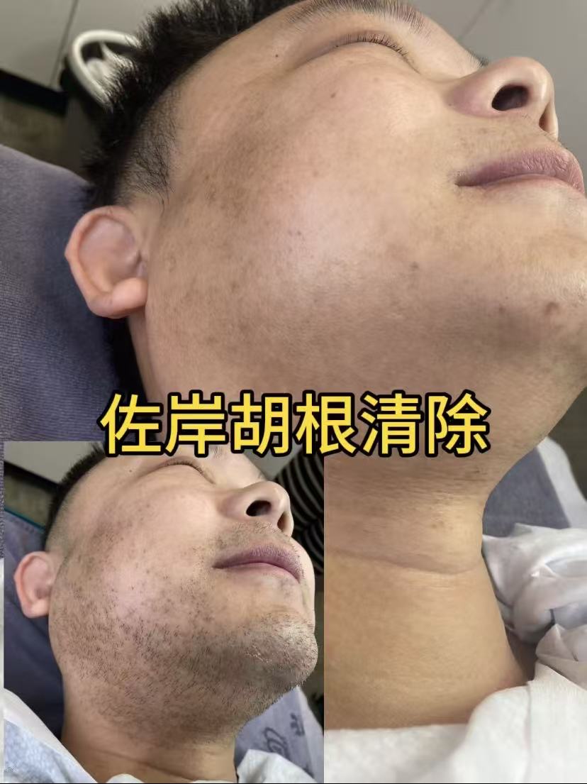绍兴脱毛